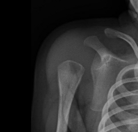 Proximal humeral metaphyseal lytic focus in a 25 days neonate.