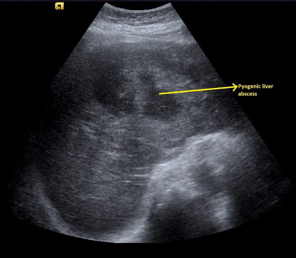 File:Pyogenic-hepatic-abscess-contrast1-enhanced-ultrasound (1).jpg