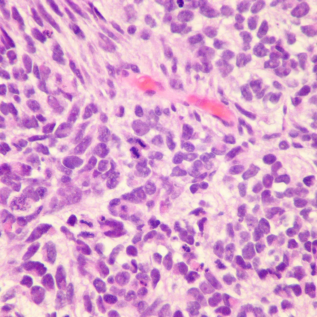 File:Small-cell-lung-cancer-histology.jpg