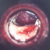 Ruptured tympanic membrane and blood in the ear canal (surgeon's view)[3].