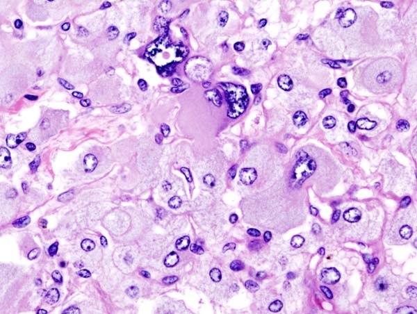 Histopathology of adrenal pheochromocytoma. Adrenectomy specimen. Source: CC BY-SA 3.0, https://commons.wikimedia.org/w/index.php?curid=535945