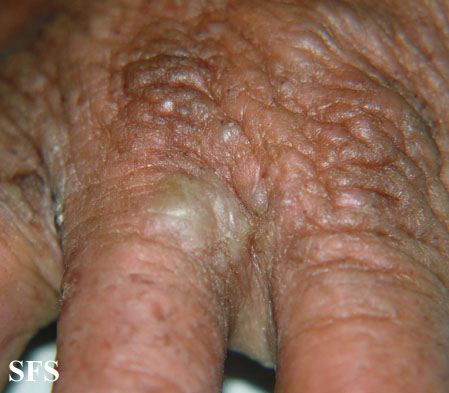 File:Darier's disease36.jpg