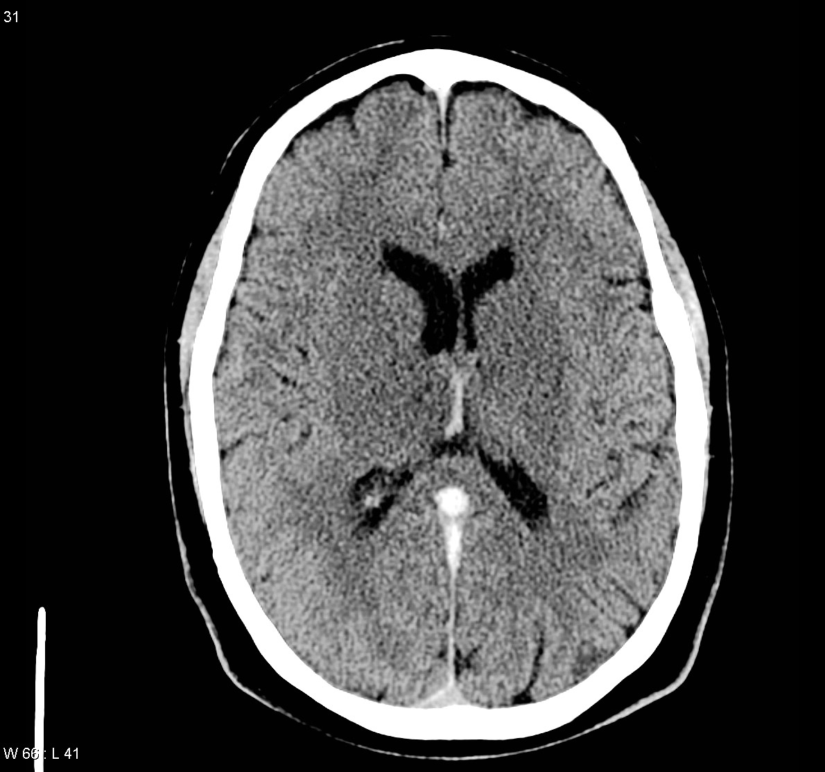 File:Internal-cerebral-vein-thrombosis-1.jpg