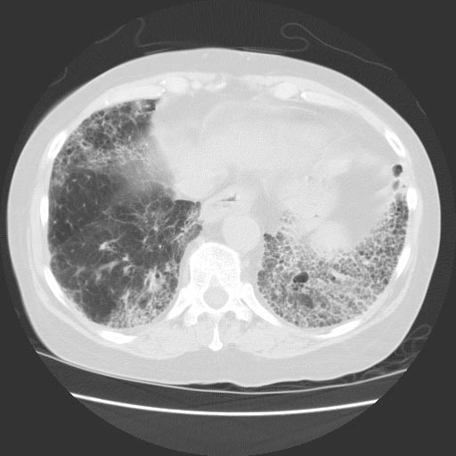 CT: Lung involvement in Scleroderma