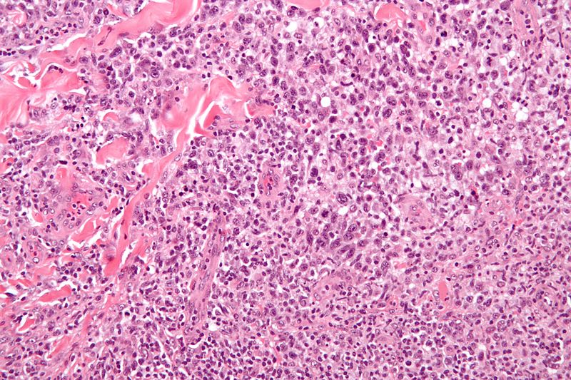 File:800px-Anaplastic large cell lymphoma - high mag.jpg