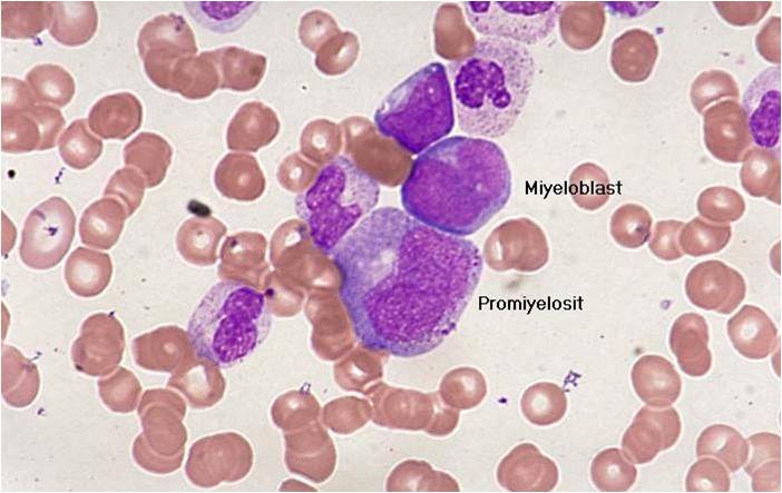 AML-M2 - large myeloblasts with prominent nucleoli.