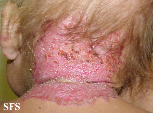 Acrodermatitis enteropathica. With permission from Dermatology Atlas.[1]