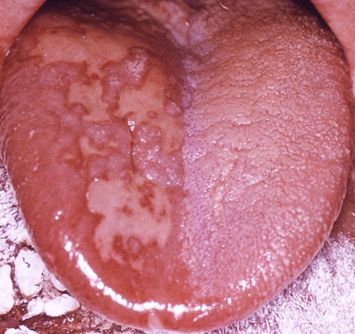 Pathologic changes seen on the surface of the right unilateral side of this elderly male patient’s tongue and chin, represent a herpes outbreak due to the Varicella-zoster virus (VZV) pathogen. From Public Health Image Library (PHIL). [3]