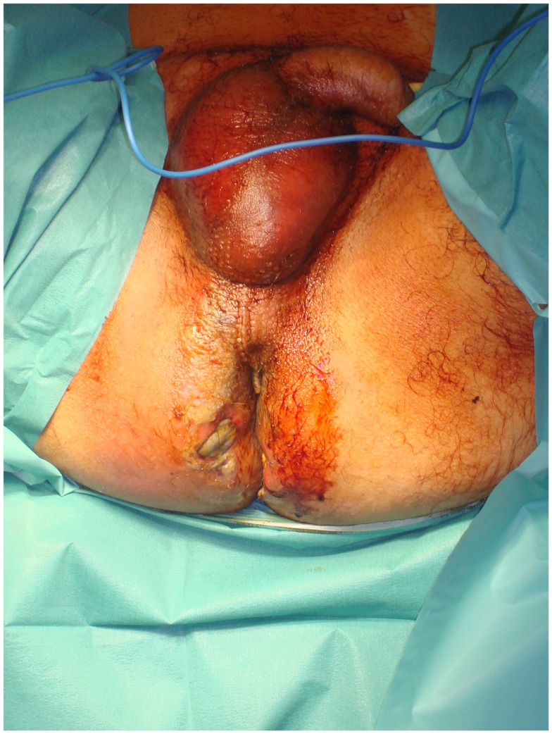 A severe case of Fournier’s gangrene with excessive erythema and edema in the perineal and gluteal regions as well as skin necrosis with bullae.[12]
