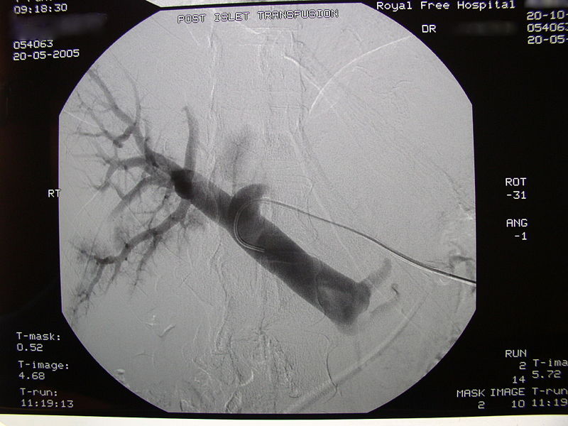 Post-transplant radiographic image of the recipient's portal tree.