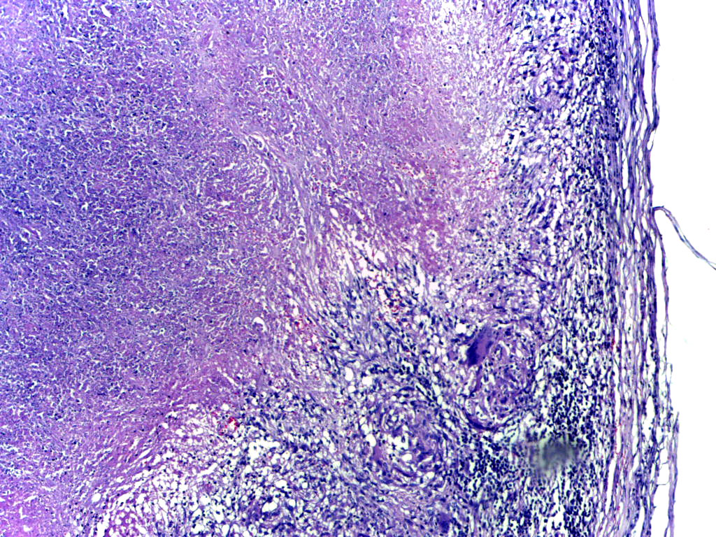 Low-power microscopy showing tuberculous epididymitis; caseous necrosis surrounded by epithelioid cells and giant cells with a mantle of lymphocytes. Adapted from https://commons.wikimedia.org/wiki/Category:Histopathology_of_tuberculous_epididymitis#/media/File:Tuberculous_epididymitis_Low_Power.jpg. Accessed on Jan 3rd, 2017.