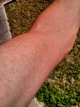 rash on arm due to Zika virus - By FRED - Own work, CC BY-SA 3.0, https://commons.wikimedia.org/w/index.php?curid=30734915