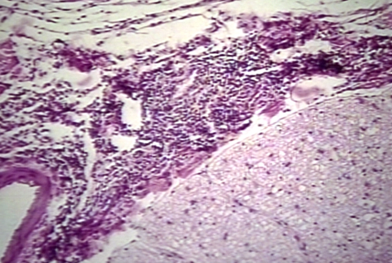 Spinal Cord: Arnold Chiari Malformation; Type II, Meningomyelitis