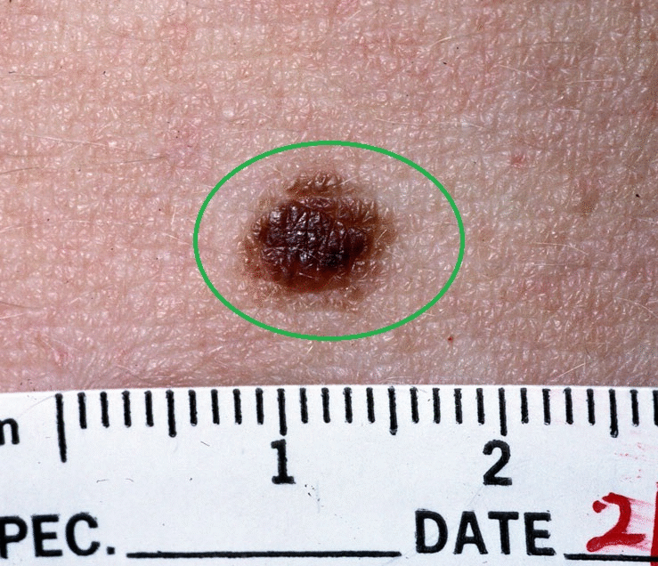 Epidermal nevi in Cowden syndrome