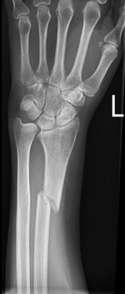 File:Galeazzi-fracture-dislocation-3 (3).jpg