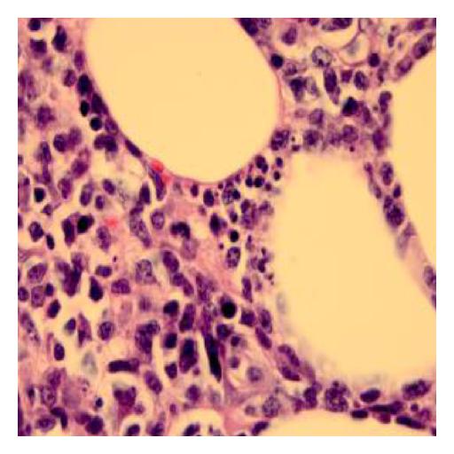 Biopsy of soft tissue : At 100x magnification with oil-immersion biopsy shows mitotic figure with scattered histiocytes and area of necrosis.[3]