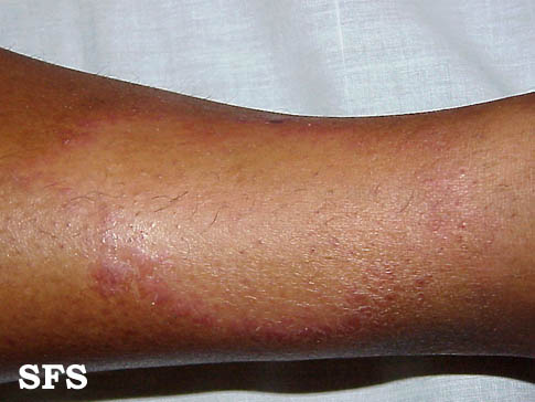 Tuberculoid leprosy. Adapted from Dermatology Atlas.[5]