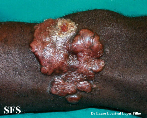 Keloidal Blastomycosis Adapted from Dermatology Atlas
