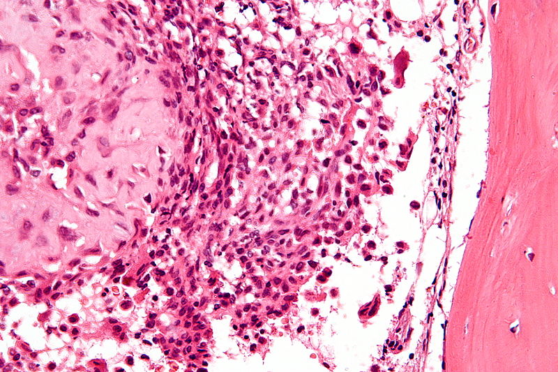 File:800px-Chondroblastoma - very high mag.jpg