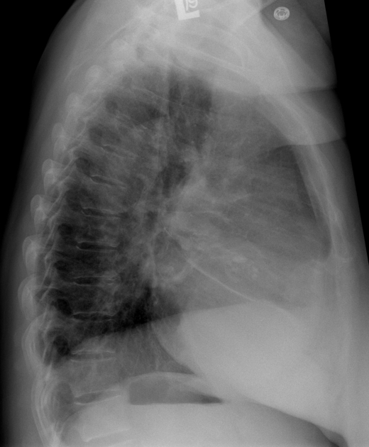 Lateral view of chest x-ray shows left ventricular enlargement due to aortic stenosis