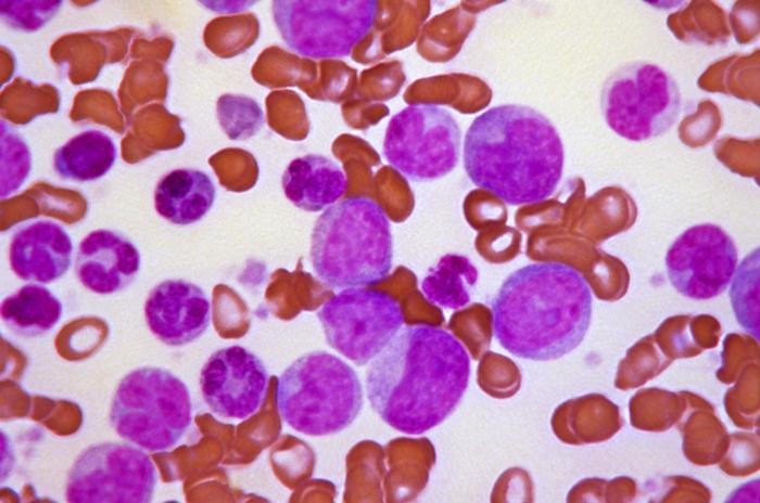 Blast crisis of chronic myelogenous leukemia (CML). Peripheral blood smear revealing the histopathologic features indicative of a blast crisis in the case of chronic myelogenous leukemia.[32]