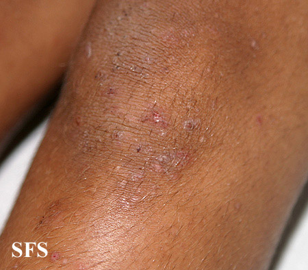 Dermatitis herpetiformis. Adapted from Dermatology Atlas.[14]