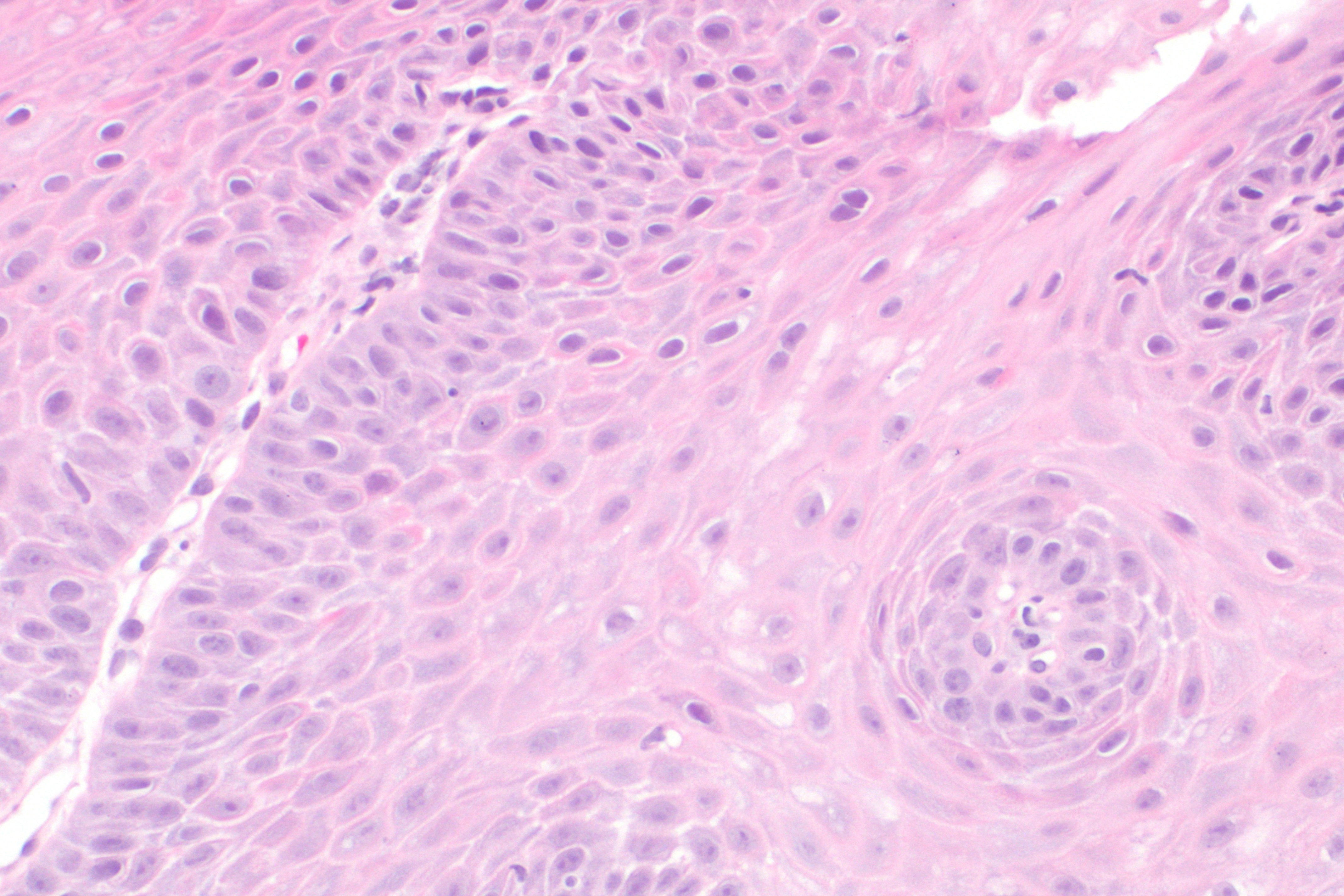 File:Gastroesophageal reflux disease -- high mag.jpg