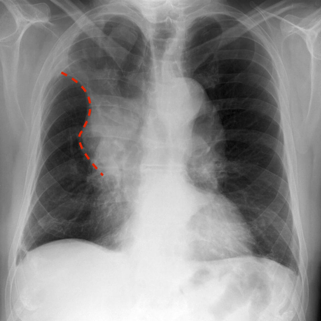 Golden "S" Sign (or reverse "S" sign of Golden) : right upper lobar collapse (the right upper lobe appearing dense and shifting medially and upwards, with a central mass expanding the hilum