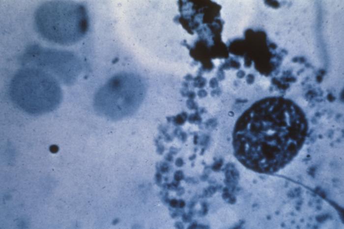 This image reveals some of the cytoarchitectural features seen in a lymph node specimen that had been extracted from a patient suspected of a Hantavirus illness. Note the concentration of lymphohistiocytic infiltrates, almost all cases have expanded paracortical regions, or T-cell regions with immunoblasts, which sometimes extend into the cortex and into the medulla. From Public Health Image Library (PHIL). [5]
