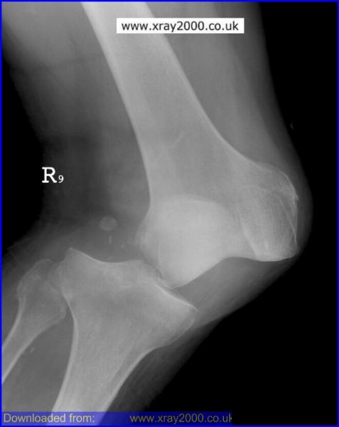 Lateral Knee Dislocation