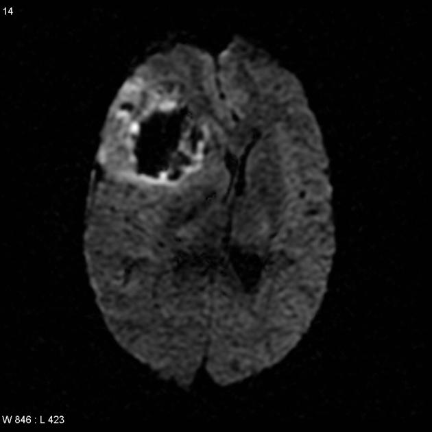 A left frontal lobe mass with central haemorrhagic component is present (intrinsic high T1, low T2) with a peripheral region of enhancement and high T2 signal. Some of the enhancement may be in reaction to the haemorrhage, depending on the time course.[5]