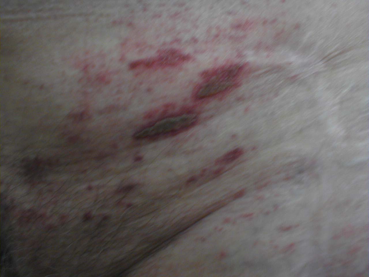 Herpes Zoster: Coalesced vesicles resulting from reativation of HZV infection.