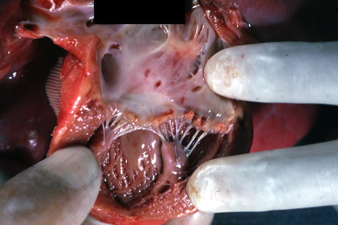 Verrucous Nonbacterial Endocarditis: (Gross) An excellent example of an infant heart