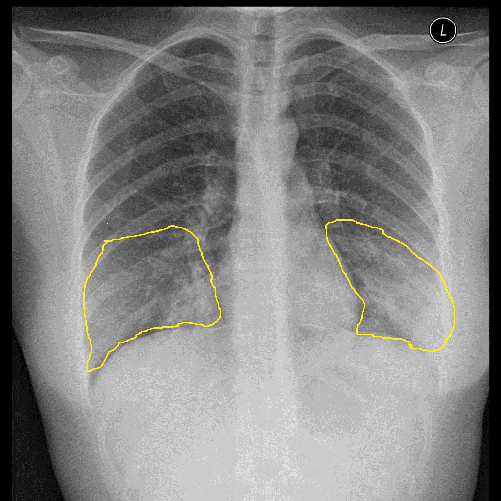File:Atypical-pneumonia-mycoplasma - Case courtesy of Dr Alborz Jahangiri, Radiopaedia.org, rID 45781.jpg