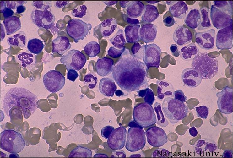 Chronic myelomonocytic leukemia ( CMMoL)