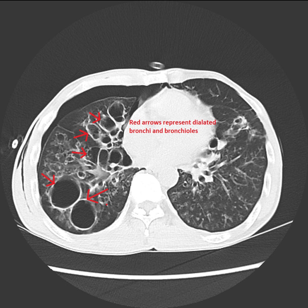 File:Cystic-bronchiectasis-causing-pneumothorax.jpg