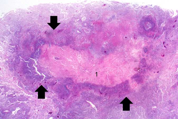 This is a low-power photomicrograph of lung tissue containing a large abscess. The center of the abscess contains necrotic debris (1) and there is a rim of viable inflammatory cells (arrows) surrounding this abscess.