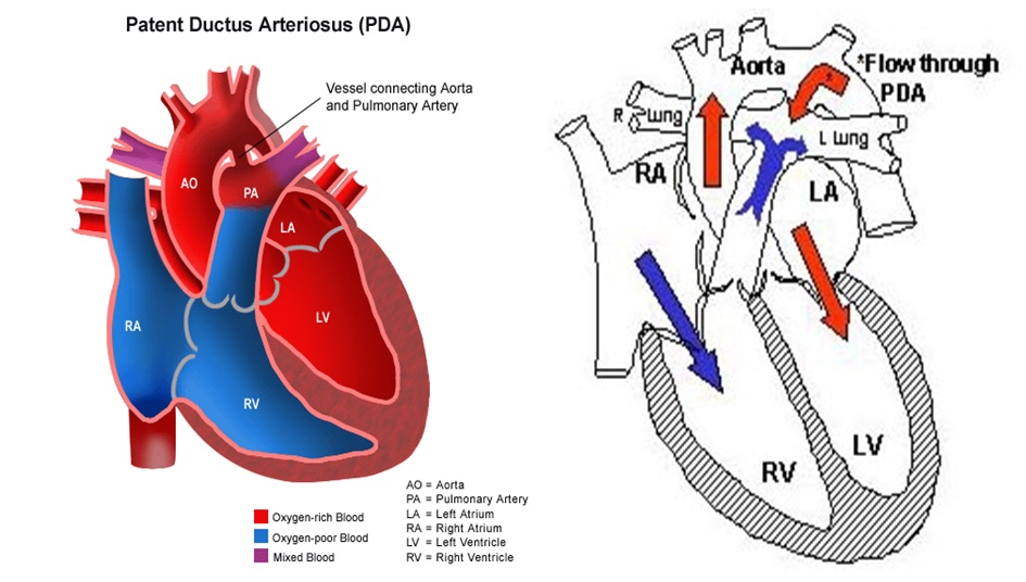 Patent ductus arteriosus pathophysiology