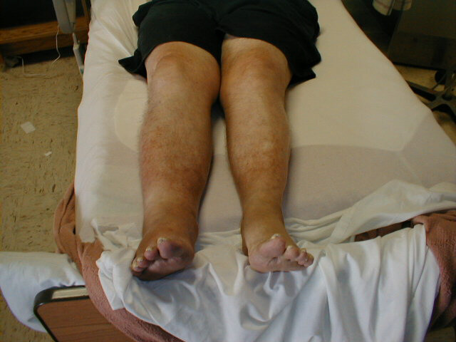 Assymetric Leg, Swelling secondary to Deep Venous Thrombosis in Right Leg