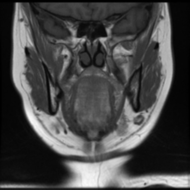 Coronal T1 MRI of squamous cell carcinoma of tongue[2]