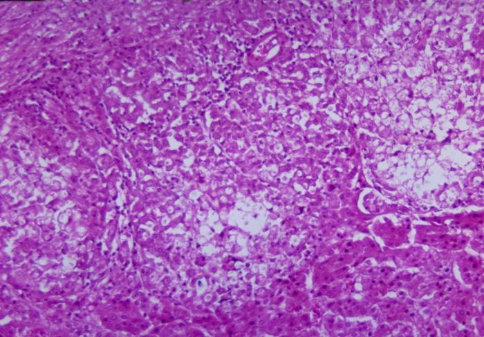 Micrograph depicts the histopathologic changes associated with cryptococcosis of an adrenal gland. From Public Health Image Library (PHIL). [7]
