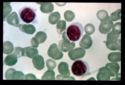 Hairy cell leukemia illustrated on a blood film[5]