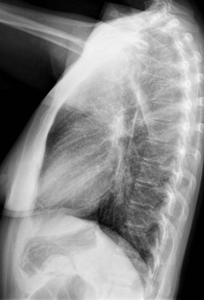 Miliary lung nodules consistent with prior and healed varicella pneumonia. [5]