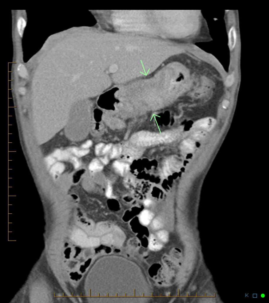 Diffuse thickening of the gastric wall in its distal 1/2. Beware false positives ie collapsed wall. The key in this case is the barium study showing failure to distend despite adequate volume load with irregular, lobulated margins to the gastric walls.[3]