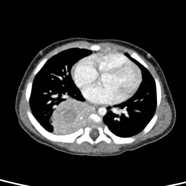 Neuroblastoma observed as a large right enhancing mass with central hypo-attenuation on transverse thoracic CT scan[3]