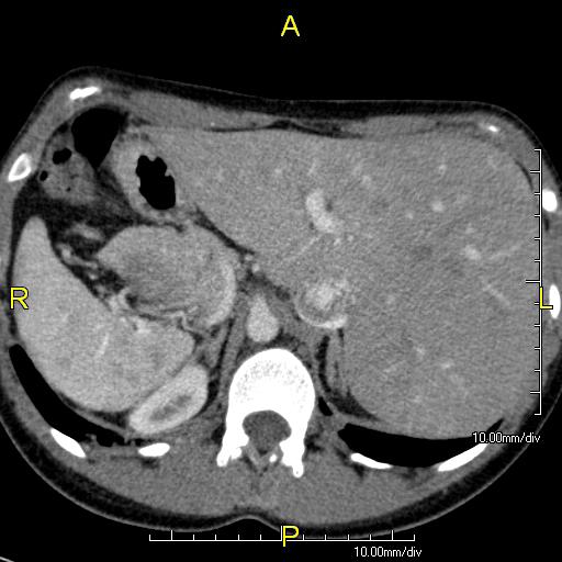 Axial CT image showing situs inversus with the liver and IVC on the left and the spleen and aorta on the right