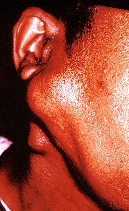 Pleomorphic adenoma (Benign mixed tumor) oral 001.jpg