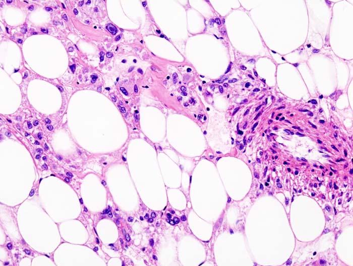 Histopathologic slide of renal angiomyolipoma. Nephrectomy specimen. H & E stain.[8]
