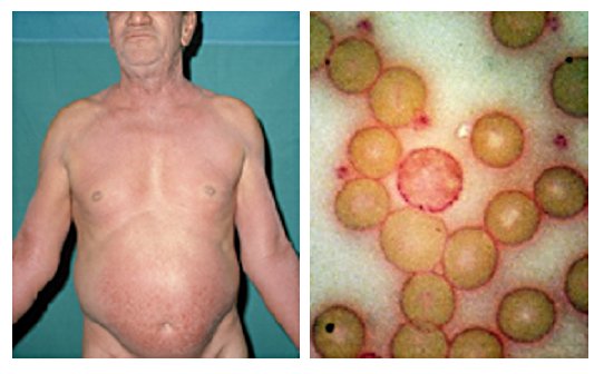 61-year-old man presented in 1972 with unrelenting pruritus of six months’ duration. On the right is his peripheral blood film stained with Periodic Acid-Schiff (PAS) showing a neoplastic T cell (Sézary cell).