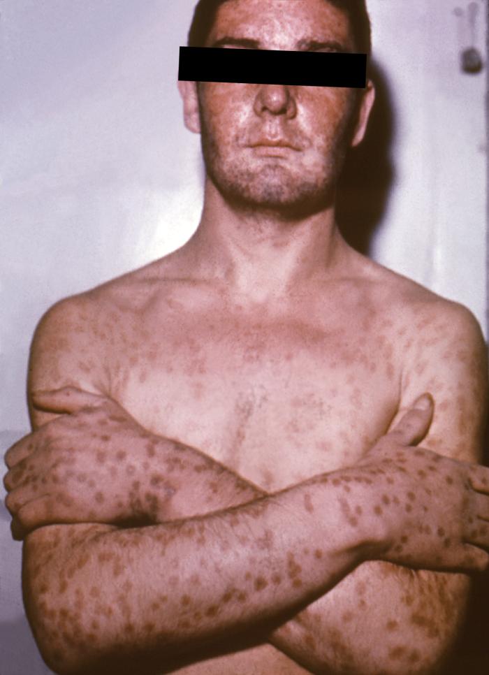 File:Smallpox 6.jpg